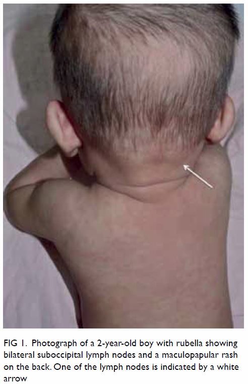 swollen supraclavicular lymph nodes in babies